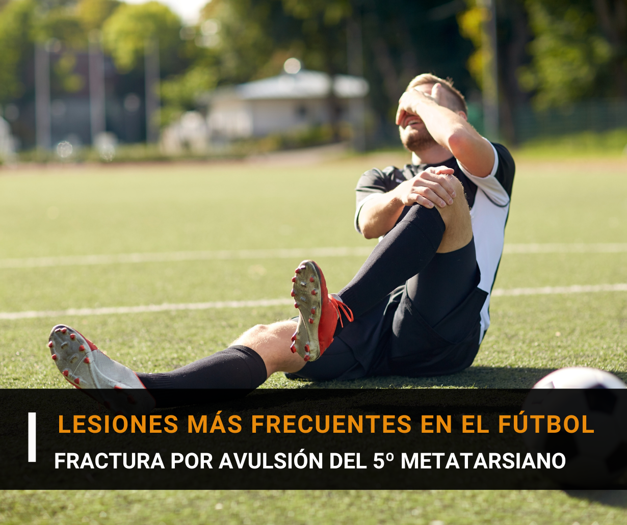 Lesiones más frecuentes en el fútbol (IV): Fractura del 5º Meta